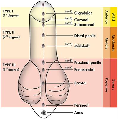 Severity-Dependent Profile of the Metabolome in Hypospadias
